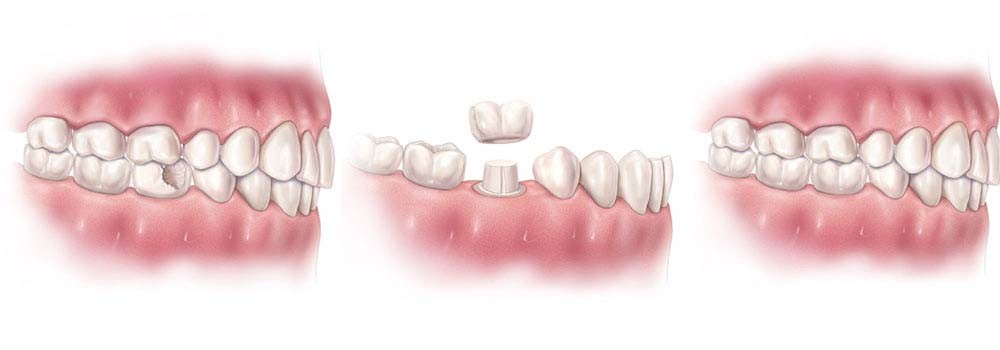 مراحل پرکردن دندان